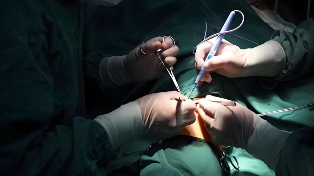 为什么手术用电刀外科医生的“魔法刀”：揭秘手术室里的高频电刀​​_https://www.jmylbn.com_新闻资讯_第3张