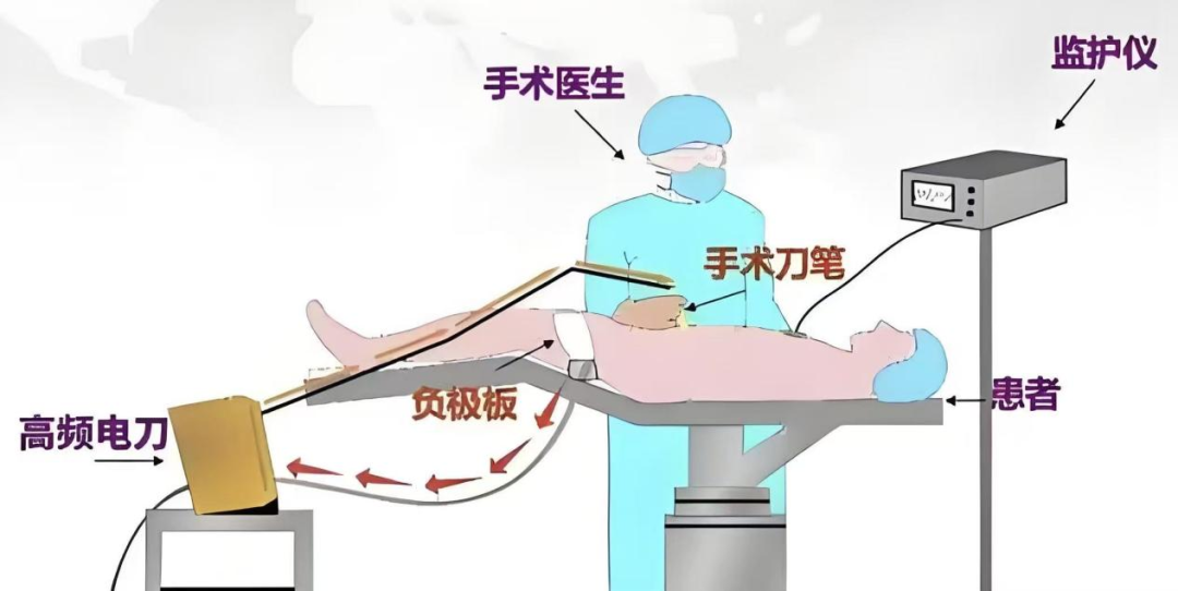 为什么手术用电刀外科医生的“魔法刀”：揭秘手术室里的高频电刀​​_https://www.jmylbn.com_新闻资讯_第4张