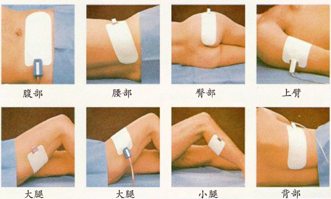 为什么手术用电刀外科医生的“魔法刀”：揭秘手术室里的高频电刀​​_https://www.jmylbn.com_新闻资讯_第7张