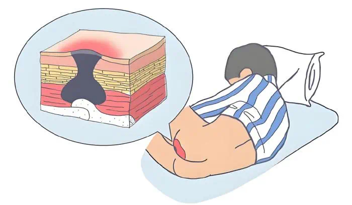 手术室体位垫怎么用健康科普丨手术中压力性损伤的预防_https://www.jmylbn.com_新闻资讯_第1张