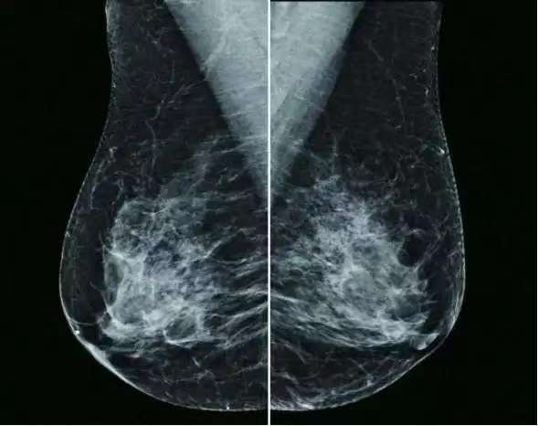 什么乳腺机【设备上新】关爱女性乳腺健康，我院新引入NeuCare乳腺机正式投入使用！_https://www.jmylbn.com_新闻资讯_第6张