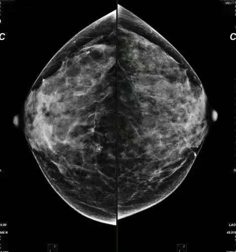 什么乳腺机【设备上新】关爱女性乳腺健康，我院新引入NeuCare乳腺机正式投入使用！_https://www.jmylbn.com_新闻资讯_第7张