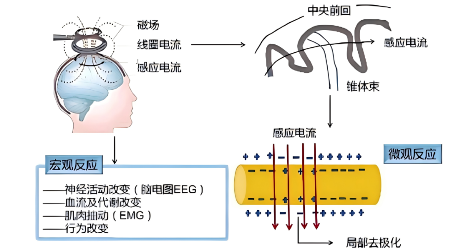 tms什么医疗【特色医疗】无创大脑调控——神奇的经颅磁刺激治疗_https://www.jmylbn.com_新闻资讯_第3张