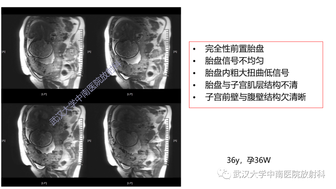 核磁共振胎盘植入图片图片