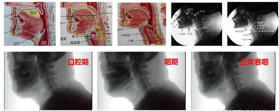 为什么要做吞咽仪器吞咽障碍，安全进食，康复有道——康复医学科吞咽康复技术介绍_https://www.jmylbn.com_新闻资讯_第8张