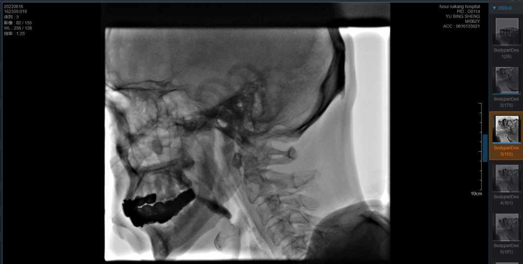 为什么要做吞咽仪器吞咽障碍，安全进食，康复有道——康复医学科吞咽康复技术介绍_https://www.jmylbn.com_新闻资讯_第12张