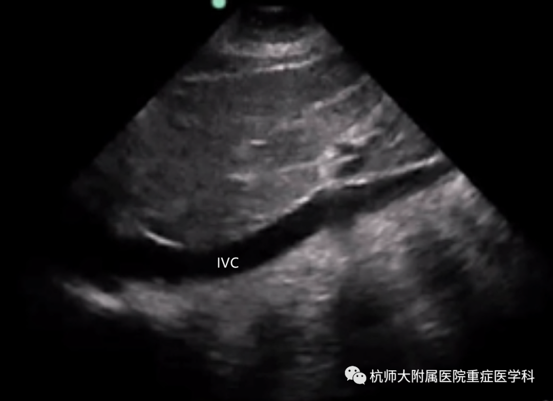 什么是超声容积探头重症心脏超声图像的获取_https://www.jmylbn.com_新闻资讯_第28张