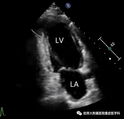 什么是超声容积探头重症心脏超声图像的获取_https://www.jmylbn.com_新闻资讯_第22张
