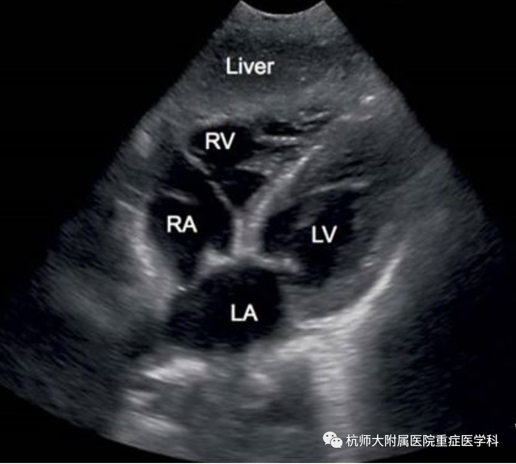 什么是超声容积探头重症心脏超声图像的获取_https://www.jmylbn.com_新闻资讯_第26张