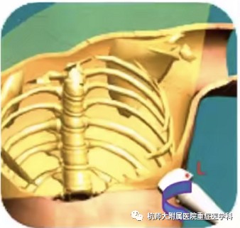 什么是超声容积探头重症心脏超声图像的获取_https://www.jmylbn.com_新闻资讯_第23张