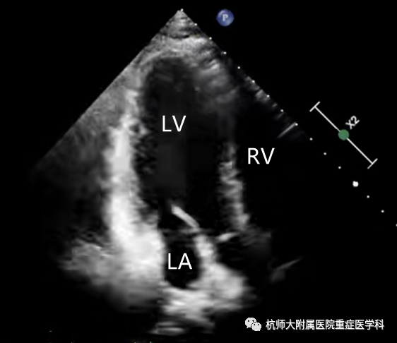 什么是超声容积探头重症心脏超声图像的获取_https://www.jmylbn.com_新闻资讯_第24张