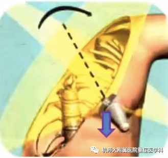 什么是超声容积探头重症心脏超声图像的获取_https://www.jmylbn.com_新闻资讯_第15张