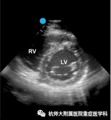 什么是超声容积探头重症心脏超声图像的获取_https://www.jmylbn.com_新闻资讯_第16张