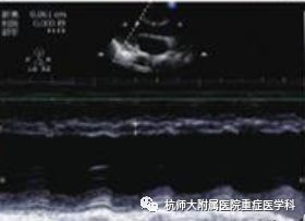 什么是超声容积探头重症心脏超声图像的获取_https://www.jmylbn.com_新闻资讯_第33张