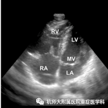 什么是超声容积探头重症心脏超声图像的获取_https://www.jmylbn.com_新闻资讯_第18张