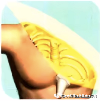 什么是超声容积探头重症心脏超声图像的获取_https://www.jmylbn.com_新闻资讯_第13张