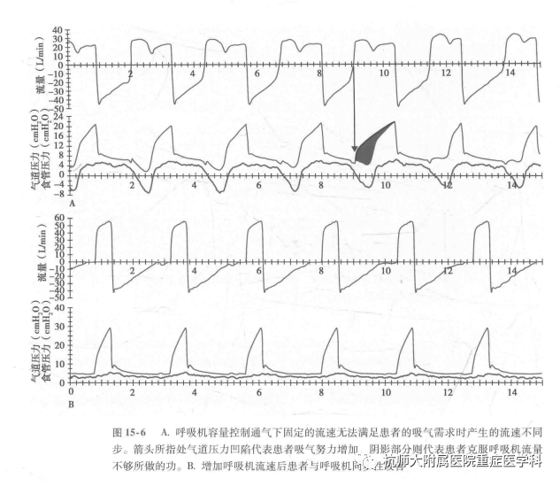 为什么呼吸机人机同步机械通气-人机不同步_https://www.jmylbn.com_新闻资讯_第6张