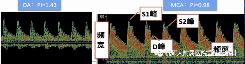 TCD怎么切换探头重症超声-颅脑多普勒血流信号的获取_https://www.jmylbn.com_新闻资讯_第22张