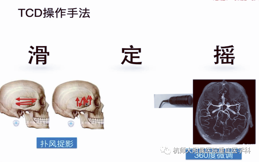TCD怎么切换探头重症超声-颅脑多普勒血流信号的获取_https://www.jmylbn.com_新闻资讯_第17张