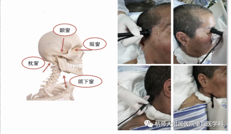 TCD怎么切换探头重症超声-颅脑多普勒血流信号的获取_https://www.jmylbn.com_新闻资讯_第16张