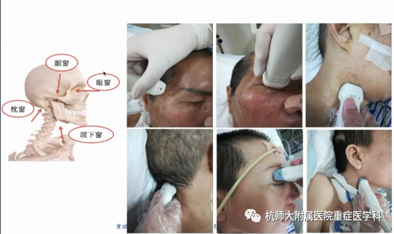 TCD怎么切换探头重症超声-颅脑多普勒血流信号的获取_https://www.jmylbn.com_新闻资讯_第20张