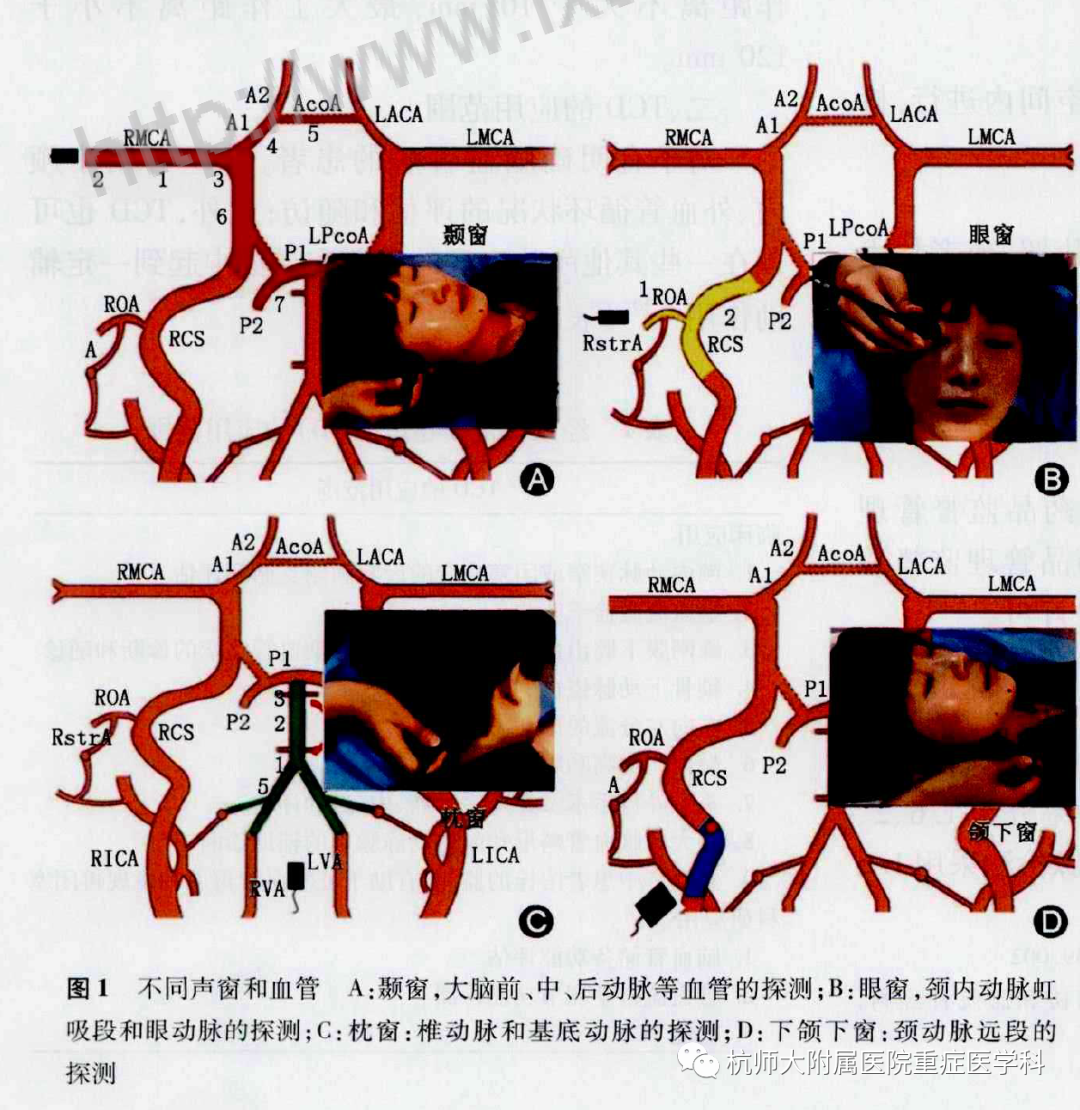 TCD怎么切换探头重症超声-颅脑多普勒血流信号的获取_https://www.jmylbn.com_新闻资讯_第6张