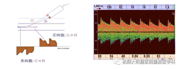 TCD怎么切换探头重症超声-颅脑多普勒血流信号的获取_https://www.jmylbn.com_新闻资讯_第19张