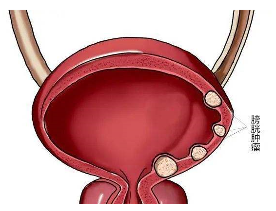 b膀胱镜为什么消毒【科普】膀胱镜检查你了解吗？_https://www.jmylbn.com_新闻资讯_第6张