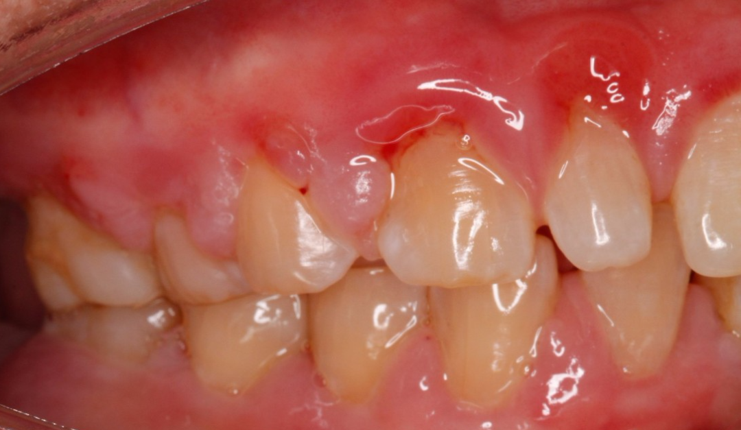 口腔激光怎么治疗你相信“光”吗？近距离了解航天中心医院口腔科激光治疗_https://www.jmylbn.com_新闻资讯_第8张