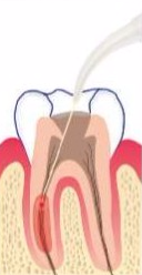 口腔激光怎么治疗你相信“光”吗？近距离了解航天中心医院口腔科激光治疗_https://www.jmylbn.com_新闻资讯_第12张