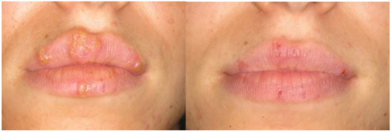 口腔激光怎么治疗你相信“光”吗？近距离了解航天中心医院口腔科激光治疗_https://www.jmylbn.com_新闻资讯_第16张