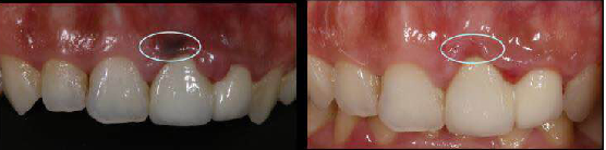 口腔激光怎么治疗你相信“光”吗？近距离了解航天中心医院口腔科激光治疗_https://www.jmylbn.com_新闻资讯_第14张