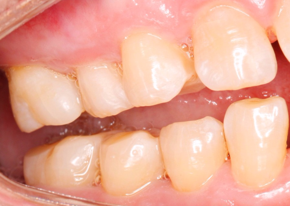 口腔激光怎么治疗你相信“光”吗？近距离了解航天中心医院口腔科激光治疗_https://www.jmylbn.com_新闻资讯_第9张