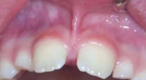 口腔激光怎么治疗你相信“光”吗？近距离了解航天中心医院口腔科激光治疗_https://www.jmylbn.com_新闻资讯_第5张