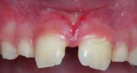 口腔激光怎么治疗你相信“光”吗？近距离了解航天中心医院口腔科激光治疗_https://www.jmylbn.com_新闻资讯_第6张