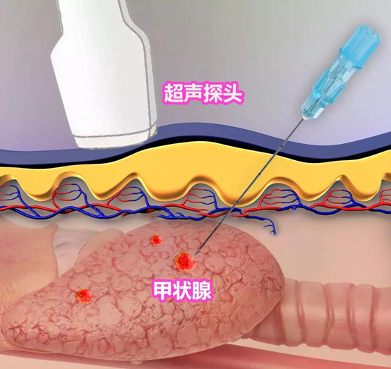 g穿刺怎么玩甲状腺结节细针穿刺（FNA）知多少_https://www.jmylbn.com_新闻资讯_第1张