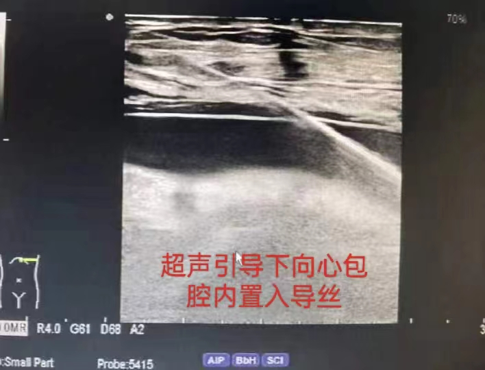 prosound超声怎么调查看部位介入超声，化解患者疾苦，为医患保驾护航！_https://www.jmylbn.com_新闻资讯_第10张