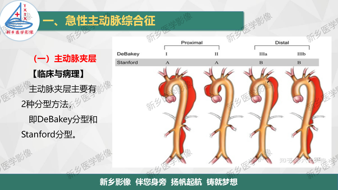 轻松鉴别主动脉夹层壁间血肿及主动脉穿透性溃疡