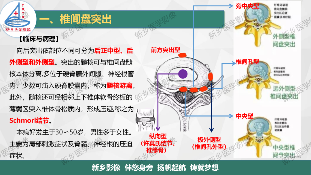 椎間盤突出解剖和分型圖解