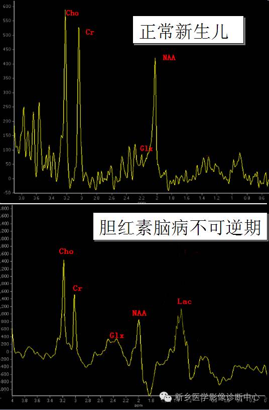 胆红素脑病_医学界-助力医生临床决策和职业成长