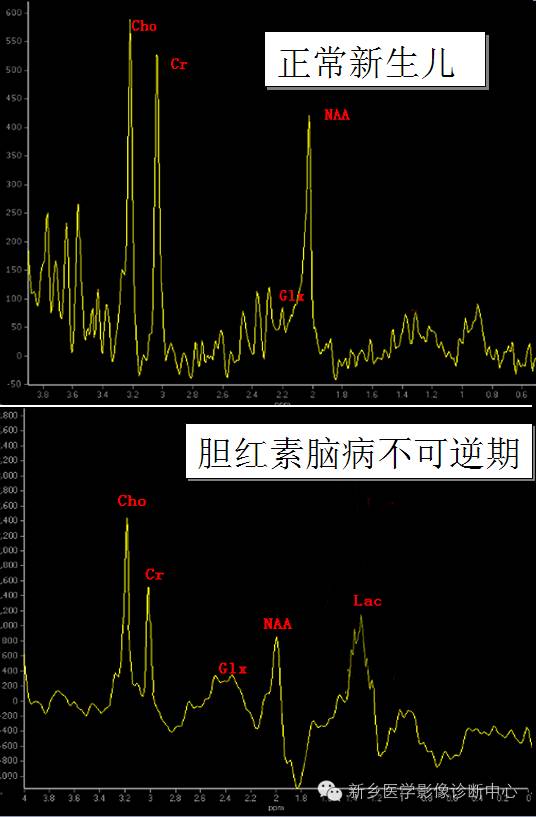 膽紅素腦病_醫學界-助力醫生臨床決策和職業成長