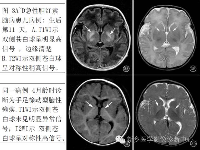 胆红素脑病_医学界-助力医生临床决策和职业成长