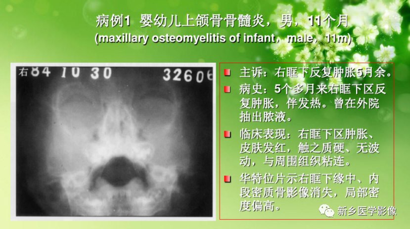 婴幼儿颌骨骨髓炎