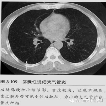 由于弥漫性泛细支气管炎多伴有鼻窦炎或有既往史,作鼻窦x线或ct检查以