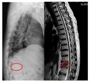 微创 | 高处坠落致胸椎爆裂性骨折,手术