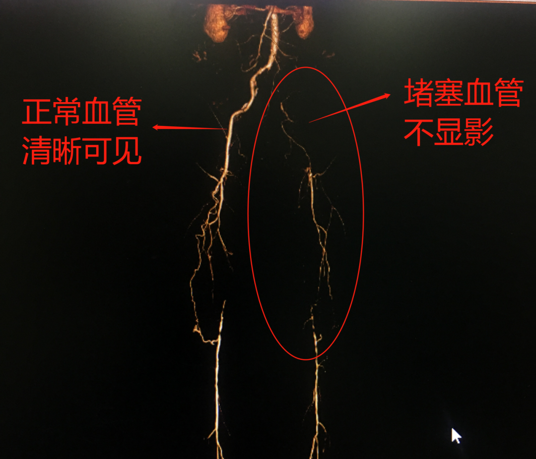 七旬老人不明原因“瘫痪”险截肢，“凶手”