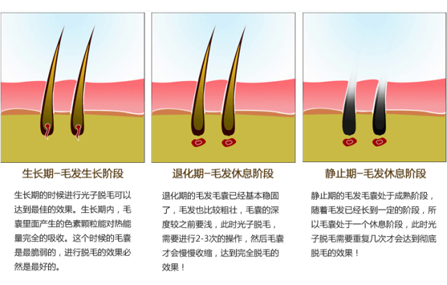 光子冷凝胶怎么使用科普 ｜ 光子脱毛，你需要了解这些～_https://www.jmylbn.com_新闻资讯_第3张