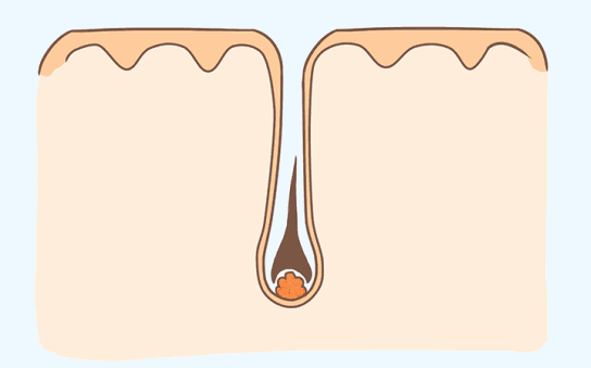 光子冷凝胶怎么使用科普 ｜ 光子脱毛，你需要了解这些～_https://www.jmylbn.com_新闻资讯_第2张