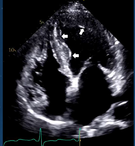 左室肥厚伴多系统受累，要警惕罕见的法布雷病