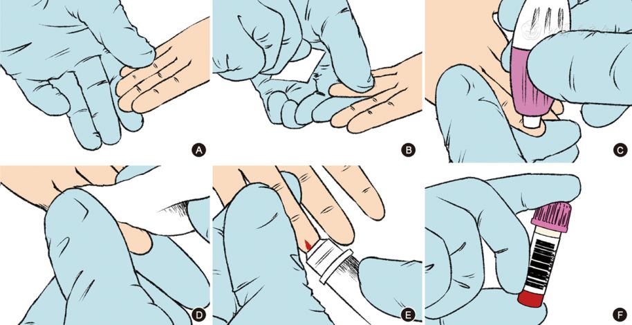 微量采血管怎么使用中国末梢采血操作共识_https://www.jmylbn.com_新闻资讯_第8张